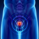Prostate cancer