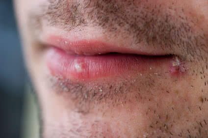 Cold Sores
