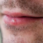 Cold Sores