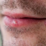 Cold Sores